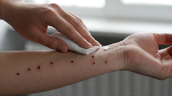 Comment traiter efficacement les piqûres de punaises de lit